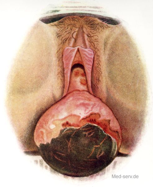 Operation Frauenheilkunde