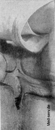 Neoplasmen Frauenheilkunde