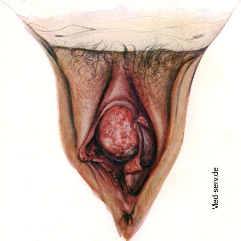 Die inneren schamlippen (labia minora, kleine schamlippen) ziehen von der m...