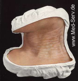 Sekundärstadium Moulage