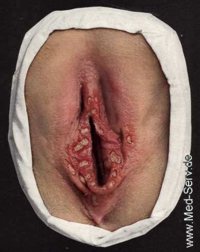 Ulcus molle Moulage