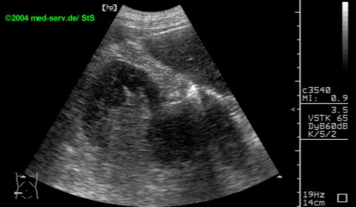 Nierenzellkarzinom Hypernephrom Sonographieatlas